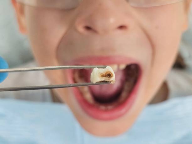 Best Emergency Broken Tooth Repair in Randolph Af, TX